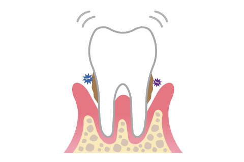 歯周病精密検査