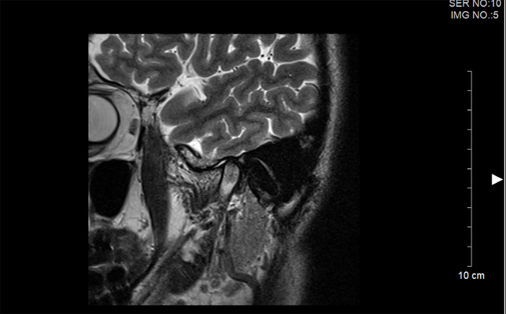 顎関節のMRI